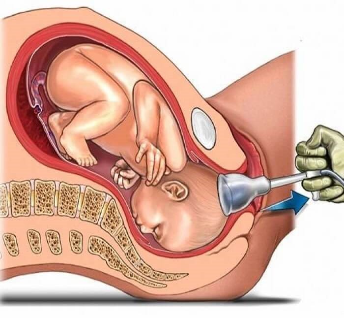 Các chị em phải tiến hành thủ thuật cắt rạch và khâu tầng sinh môn, sau khi sinh