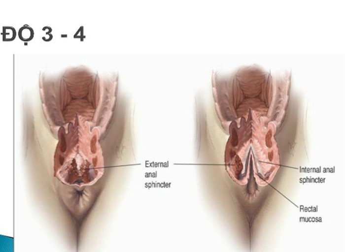 Tầng sinh môn là phần mô nằm giữa âm đạo và hậu môn, tầng sinh môn có chiều dài khoảng 3 - 5cm